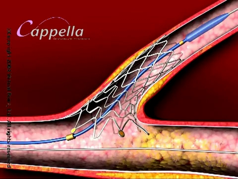 Cardiology heart valve stent,3D medical animation produced by Virtual Point[2]